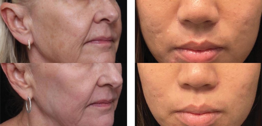 Before and After Images of UltraClear Laser Rejuvenation