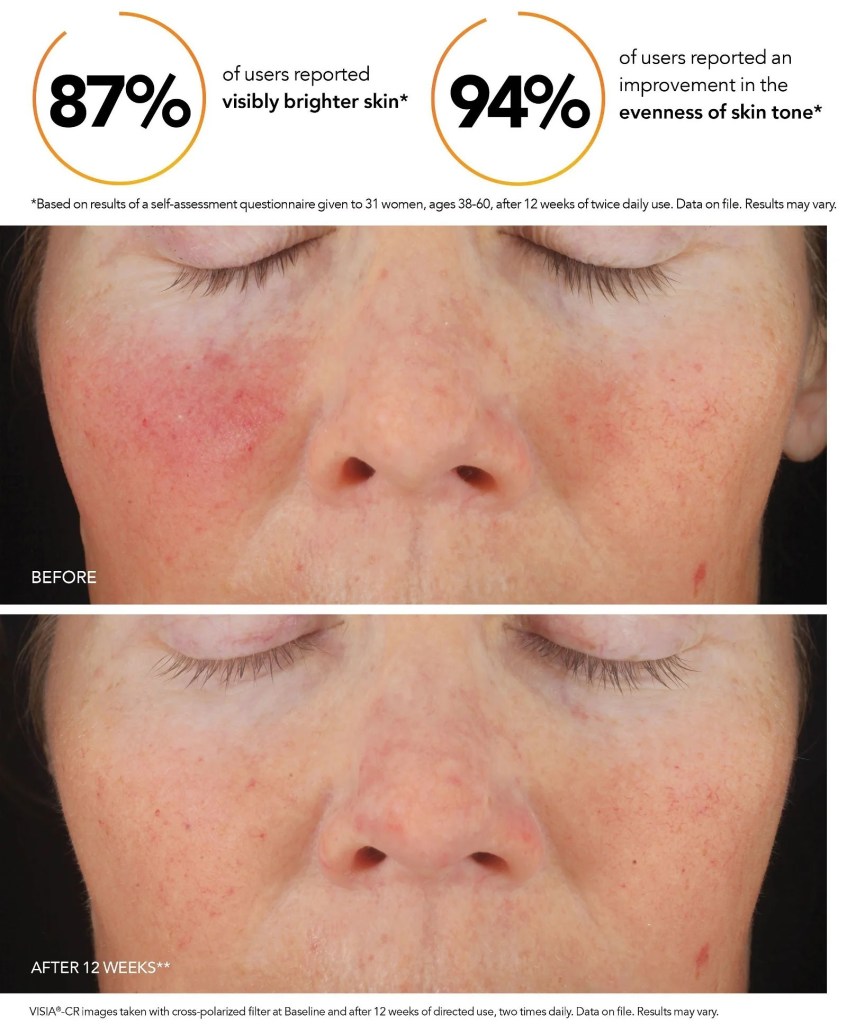 Revision C+ Correcting Complex Before and After Picture