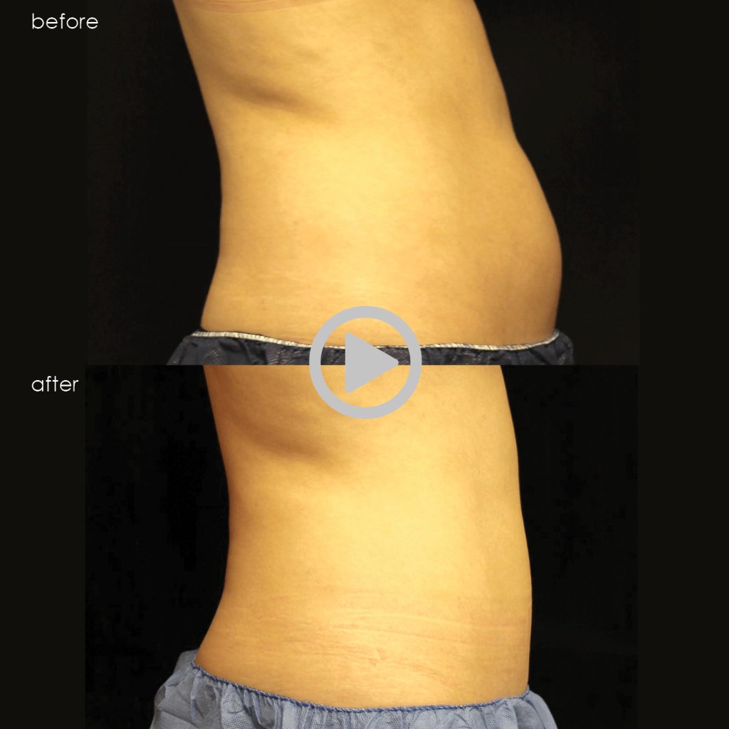 CoolSculpting Before & After