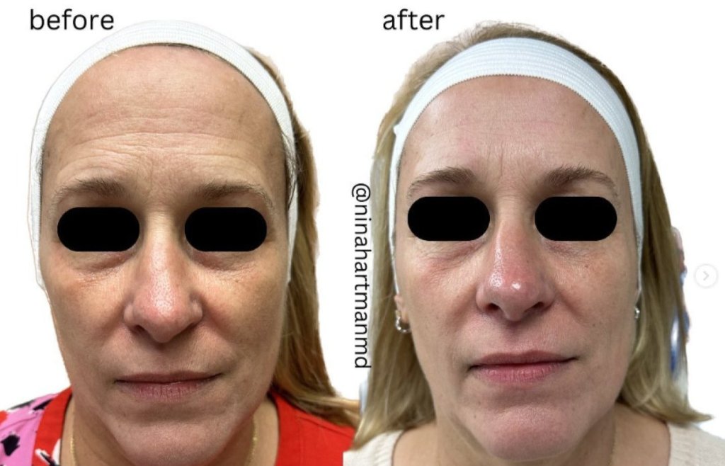 Smart TCA Peel Before & After